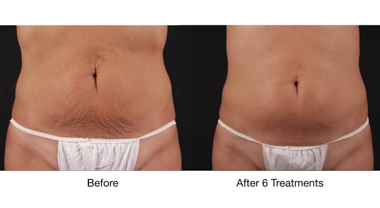 body treatments